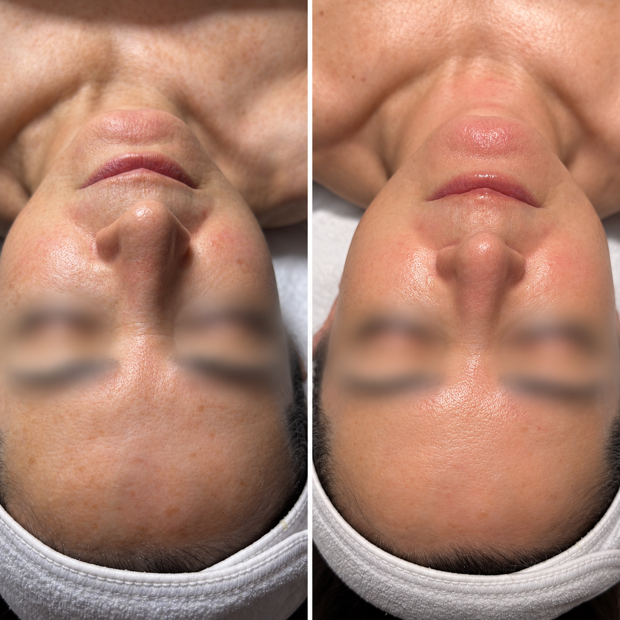 Unretouched before-and-after photos of a client's face and neck following a professional skincare treatment