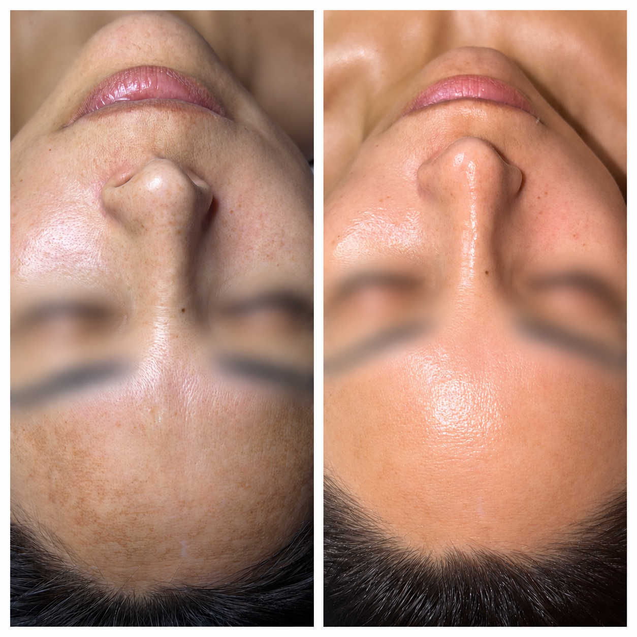 Unretouched before-and-after photos of a client's face following a professional skincare treatment