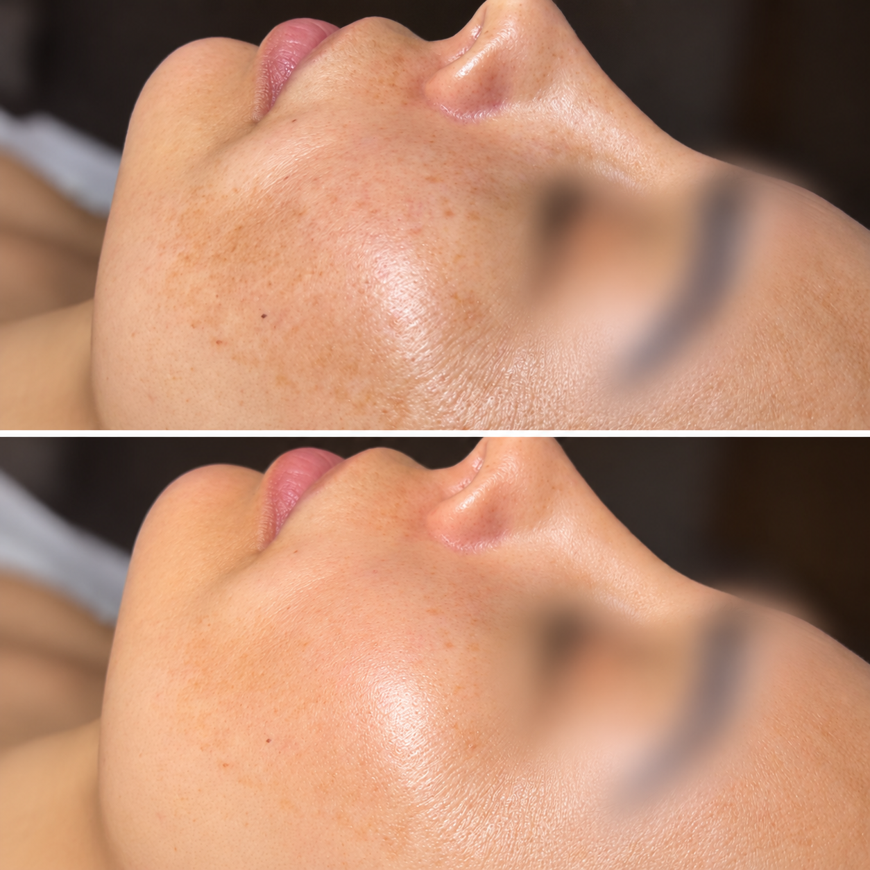 Unretouched before-and-after close-up of a client's cheek following a professional skincare treatment